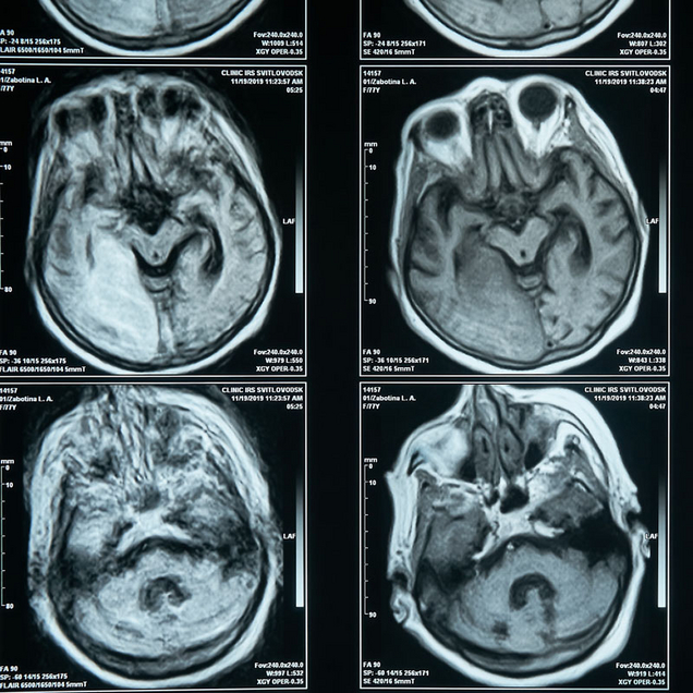 MRI Magnetresonanz Imaging (Foto: AdobeStock)